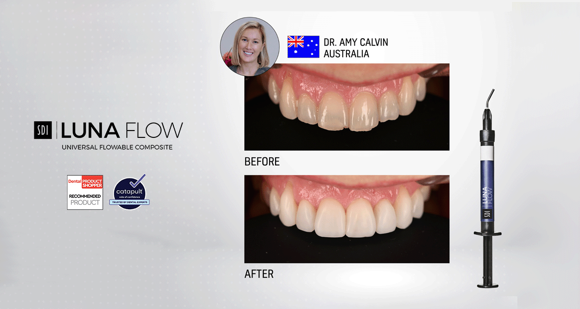 SDI Luna Flow. A Versatile Solution for Modern Restorative Dentistry